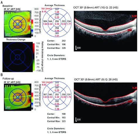 thickness measurement of retinal layers|retinal thickness map.